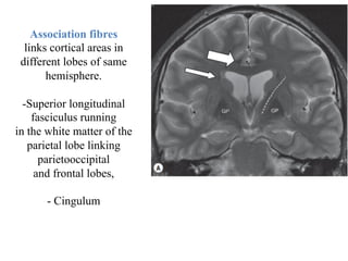 Association fibres
links cortical areas in
different lobes of same
hemisphere.
-Superior longitudinal
fasciculus running
in the white matter of the
parietal lobe linking
parietooccipital
and frontal lobes,
- Cingulum
 