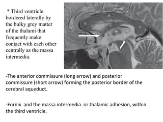 -The	anterior	commissure	(long	arrow)	and	posterior	
commissure	(short	arrow)	forming	the	posterior	border	of	the	
cerebral	aqueduct.	
	
-Fornix		and	the	massa	intermedia		or	thalamic	adhesion,	within	
the	third	ventricle.	
	
* Third ventricle
bordered laterally by
the bulky grey matter
of the thalami that
frequently make
contact with each other
centrally as the massa
intermedia.
 