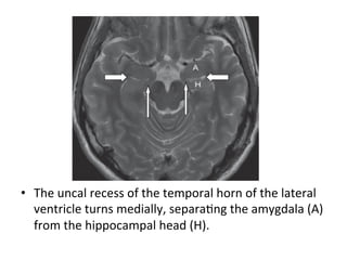 •  The	uncal	recess	of	the	temporal	horn	of	the	lateral	
ventricle	turns	medially,	separaHng	the	amygdala	(A)	
from	the	hippocampal	head	(H).
 