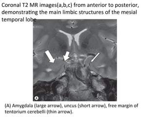 (A)	Amygdala	(large	arrow),	uncus	(short	arrow),	free	margin	of	
tentorium	cerebelli	(thin	arrow).		
Coronal	T2	MR	images(a,b,c)	from	anterior	to	posterior,	
demonstraHng	the	main	limbic	structures	of	the	mesial	
temporal	lobe	
	
 