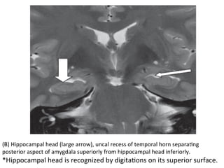 (B)	Hippocampal	head	(large	arrow),	uncal	recess	of	temporal	horn	separaHng	
posterior	aspect	of	amygdala	superiorly	from	hippocampal	head	inferiorly.		
*Hippocampal	head	is	recognized	by	digitaHons	on	its	superior	surface.	
 