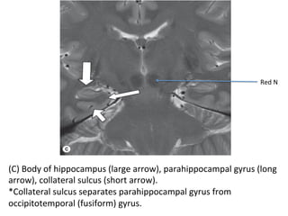 (C)	Body	of	hippocampus	(large	arrow),	parahippocampal	gyrus	(long	
arrow),	collateral	sulcus	(short	arrow).	
*Collateral	sulcus	separates	parahippocampal	gyrus	from	
occipitotemporal	(fusiform)	gyrus.	
Red	N	
 
