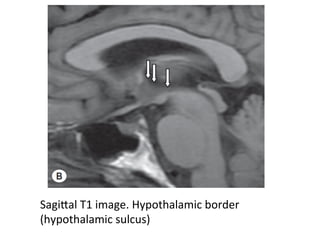 SagiTal	T1	image.	Hypothalamic	border	
(hypothalamic	sulcus)	
 