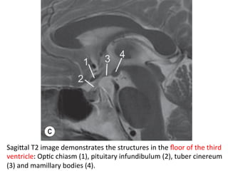 SagiTal	T2	image	demonstrates	the	structures	in	the	ﬂoor	of	the	third	
ventricle:	OpHc	chiasm	(1),	pituitary	infundibulum	(2),	tuber	cinereum	
(3)	and	mamillary	bodies	(4).	
 