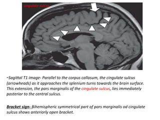 -Sagi<al	T1	image-	Parallel	to	the	corpus	callosum,	the	cingulate	sulcus	
(arrowheads)	as	it	approaches	the	splenium	turns	towards	the	brain	surface.	
This	extension,	the	pars	marginalis	of	the	cingulate	sulcus,	lies	immediately	
posterior	to	the	central	sulcus.	
	
Bracket	sign-	Bihemispheric	symmetrical	part	of	pars	marginalis	od	cingulate	
sulcus	shows	anteriorly	open	bracket.	
cingulate	sulcus	
 
