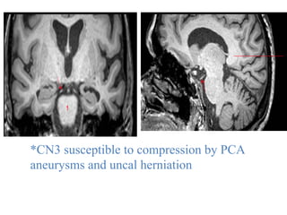 *CN3 susceptible to compression by PCA
aneurysms and uncal herniation
 