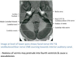 Image	at	level	of	lower	pons	shows	facial	nerve	CN	7	&	
vesHbulocochlear	nerve	CN8	coursing	towards	interior	auditory	canal.	
	
-	Nodulus	of	vermis	may	protrude	into	fourth	ventricle	&	cause	a	
pseudolesion.	
 