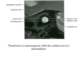 *Facial nerve is anterosuperior while the cochlear nerve is
anteroinferior
 