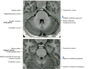 mid	pons	
Upper	pons	
 