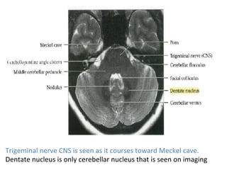 Trigeminal	nerve	CNS	is	seen	as	it	courses	toward	Meckel	cave.		
Dentate	nucleus	is	only	cerebellar	nucleus	that	is	seen	on	imaging	
 