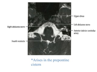 C6!
*Arises in the prepontine
cistern
 