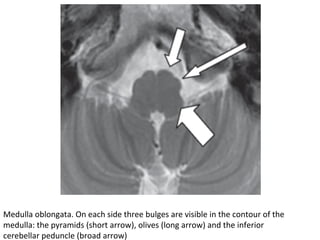 Medulla	oblongata.	On	each	side	three	bulges	are	visible	in	the	contour	of	the	
medulla:	the	pyramids	(short	arrow),	olives	(long	arrow)	and	the	inferior	
cerebellar	peduncle	(broad	arrow)
 