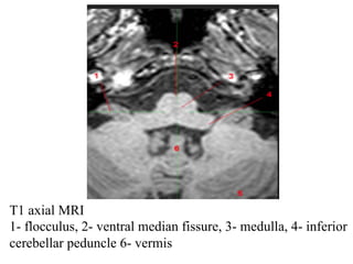 T1 axial MRI
1- flocculus, 2- ventral median fissure, 3- medulla, 4- inferior
cerebellar peduncle 6- vermis
 