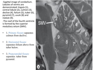 -SagiTal	image	of	cerebellum.	
Lobules	of	vermis	are	
demonstrated:	lingula	(1),	
central	lobule	(2),	culmen	(3),	
declive	(4),	folium	(5),	tuber	(6),	
pyramid	(7),	uvule	(8)	and	
nodule	(9).		
-The	roof	of	the	fourth	ventricle	
is	formed	by	the	superior	
medullary	velum	(SMV).	
	
•  1. Primary fissure separates
culmen from declive.
•  2. Horizontal fissure
separates folium above from
tuber below.	
•  3. Prepyramidal fissure
separates tuber from
pyramid.
1	
2	
3	
 