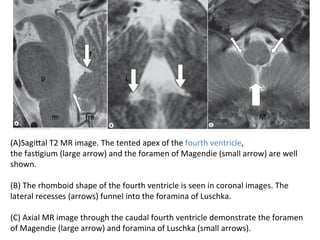 (A)SagiTal	T2	MR	image.	The	tented	apex	of	the	fourth	ventricle,	
the	fasHgium	(large	arrow)	and	the	foramen	of	Magendie	(small	arrow)	are	well	
shown.		
	
(B)	The	rhomboid	shape	of	the	fourth	ventricle	is	seen	in	coronal	images.	The	
lateral	recesses	(arrows)	funnel	into	the	foramina	of	Luschka.	
		
(C)	Axial	MR	image	through	the	caudal	fourth	ventricle	demonstrate	the	foramen	
of	Magendie	(large	arrow)	and	foramina	of	Luschka	(small	arrows).
p	
m	
f	
fm	
L	
M	
 