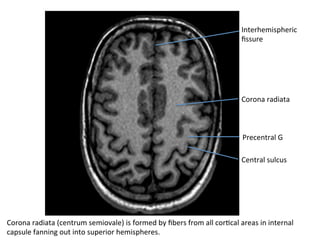 Corona	radiata	
Central	sulcus	
Precentral	G	
Corona	radiata	(centrum	semiovale)	is	formed	by	ﬁbers	from	all	corHcal	areas	in	internal	
capsule	fanning	out	into	superior	hemispheres.	
Interhemispheric	
ﬁssure	
 