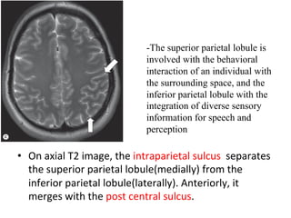 •  On	axial	T2	image,	the	intraparietal	sulcus		separates	
the	superior	parietal	lobule(medially)	from	the	
inferior	parietal	lobule(laterally).	Anteriorly,	it	
merges	with	the	post	central	sulcus.
-The superior parietal lobule is
involved with the behavioral
interaction of an individual with
the surrounding space, and the
inferior parietal lobule with the
integration of diverse sensory
information for speech and
perception
 