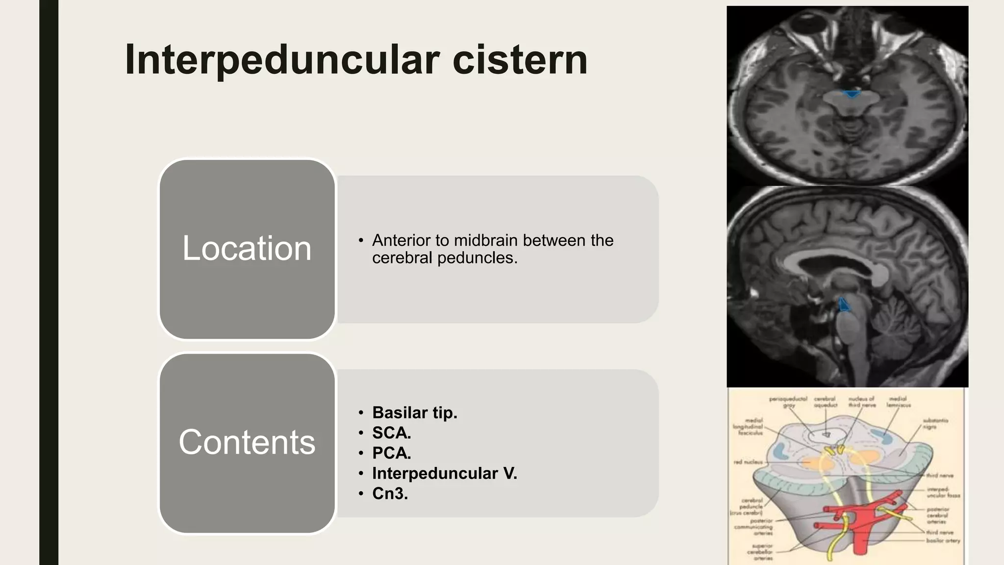 Interpeduncular cistern
• Anterior to midbrain between the
cerebral peduncles.Location
• Basilar tip.
• SCA.
• PCA.
• Interpeduncular V.
• Cn3.
Contents
 