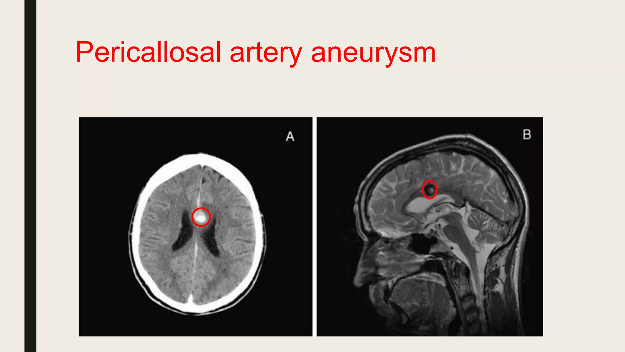 Pericallosal artery aneurysm
 