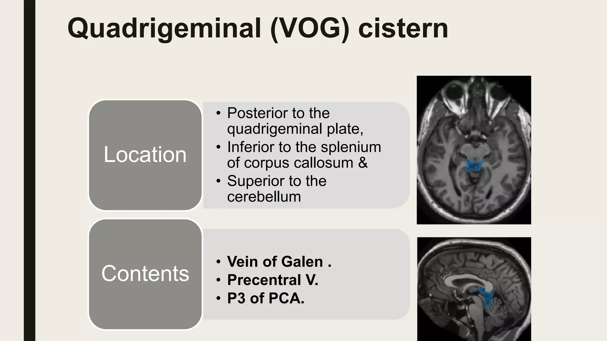 Quadrigeminal (VOG) cistern
• Posterior to the
quadrigeminal plate,
• Inferior to the splenium
of corpus callosum &
• Superior to the
cerebellum
Location
• Vein of Galen .
• Precentral V.
• P3 of PCA.
Contents
 