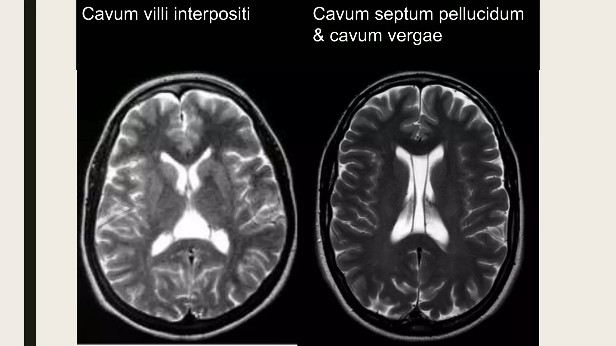 Cavum villi interpositi Cavum septum pellucidum
& cavum vergae
 
