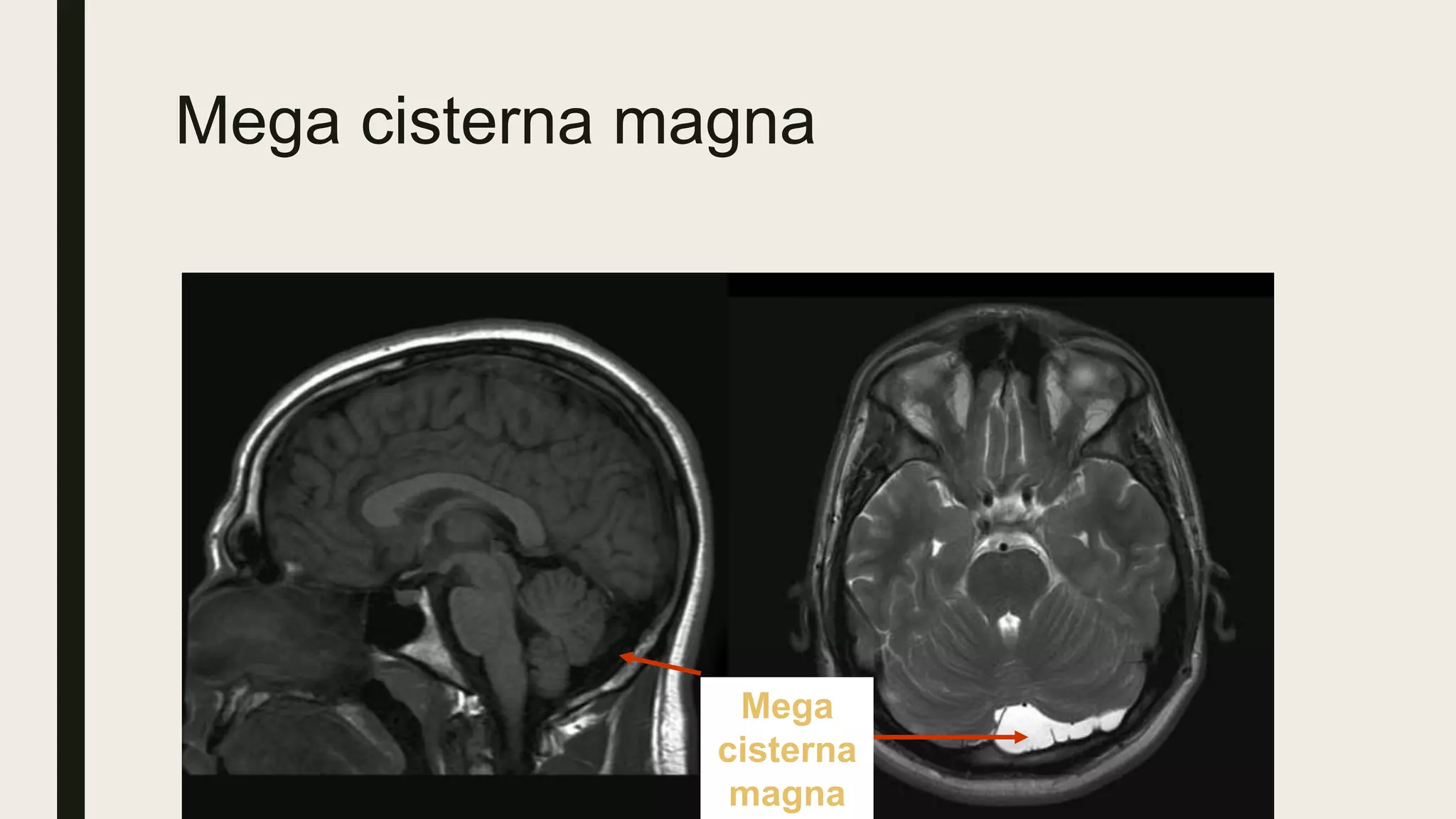 Mega cisterna magna
Mega
cisterna
magna
 