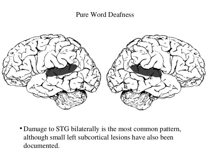 Brain And Aphasia brain-and-aphasia