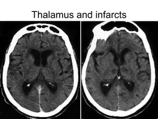 Thalamus and infarcts 