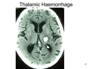 Thalamic Haemorrhage 