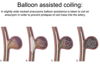 Coiling Assisted Brain aneurysm coiling | PPT