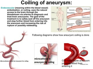 Endovascular Neurosurgery | PPT
