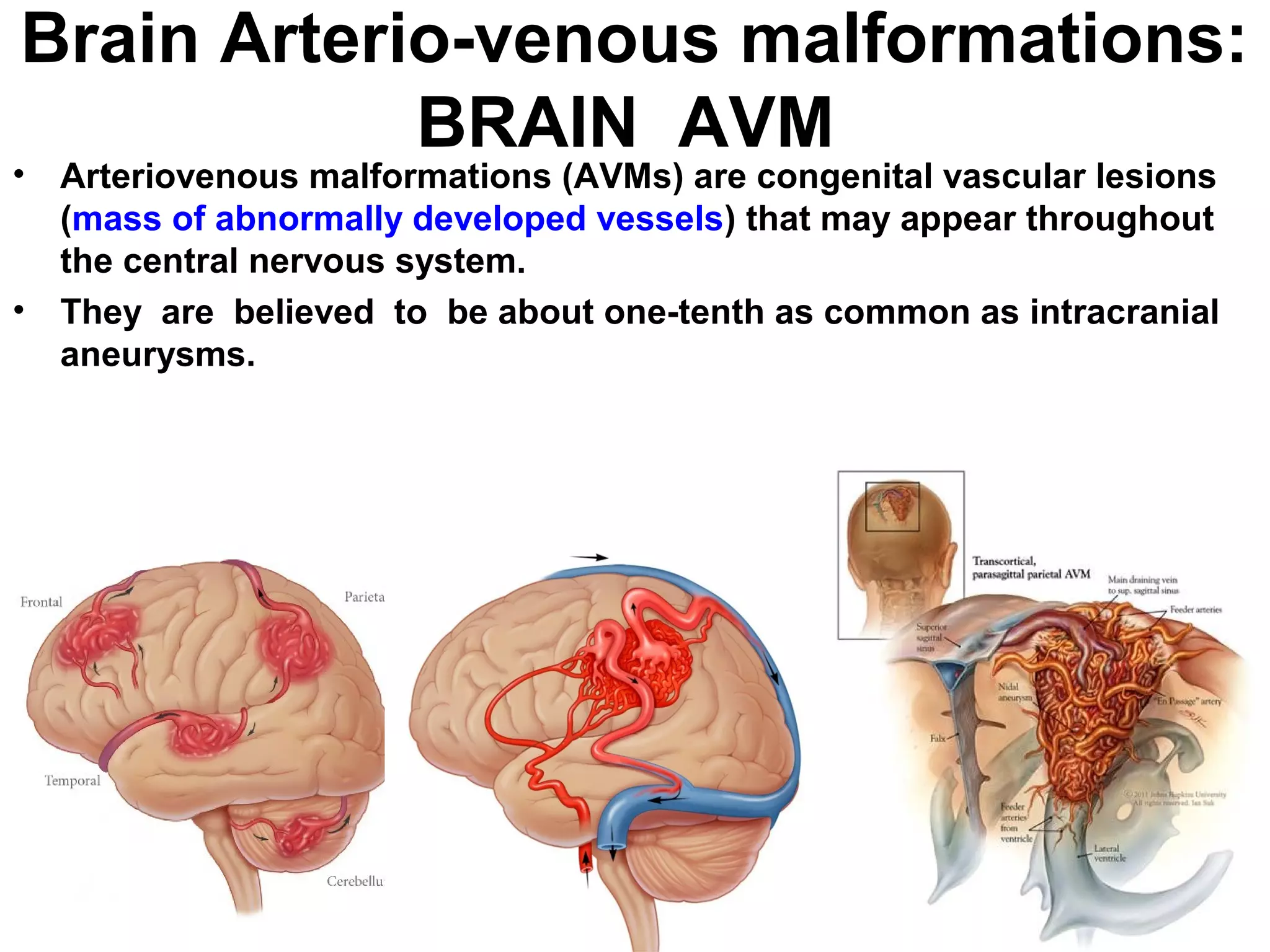 Brain avm | PPT