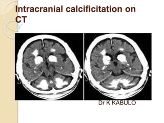 Intracranial calcificitation on
CT
Dr K KABULO
 