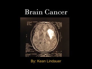 Brain Cancer
By: Kean Lindauer
 
