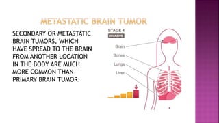 SECONDARY OR METASTATIC
BRAIN TUMORS, WHICH
HAVE SPREAD TO THE BRAIN
FROM ANOTHER LOCATION
IN THE BODY ARE MUCH
MORE COMMON THAN
PRIMARY BRAIN TUMOR.
 