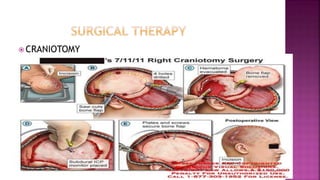  CRANIOTOMY
 