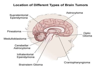 Brain cancer (tumors)