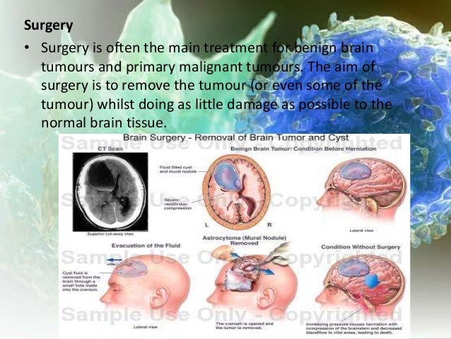 Brain cancer (tumors)