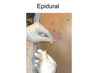 Epidural
 