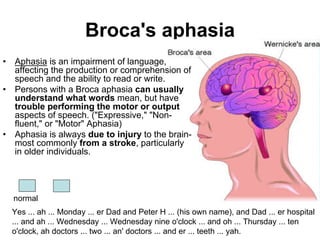 Broca's aphasia
• Aphasia is an impairment of language,
affecting the production or comprehension of
speech and the ability to read or write.
• Persons with a Broca aphasia can usually
understand what words mean, but have
trouble performing the motor or output
aspects of speech. ("Expressive," "Non-
fluent," or "Motor" Aphasia)
• Aphasia is always due to injury to the brain-
most commonly from a stroke, particularly
in older individuals.
normal
Yes ... ah ... Monday ... er Dad and Peter H ... (his own name), and Dad ... er hospital
... and ah ... Wednesday ... Wednesday nine o'clock ... and oh ... Thursday ... ten
o'clock, ah doctors ... two ... an' doctors ... and er ... teeth ... yah.
 