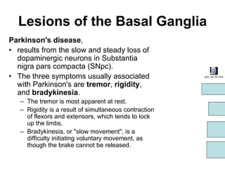 Lesions of the Basal Ganglia
Parkinson's disease,
• results from the slow and steady loss of
dopaminergic neurons in Substantia
nigra pars compacta (SNpc).
• The three symptoms usually associated
with Parkinson's are tremor, rigidity,
and bradykinesia.
– The tremor is most apparent at rest.
– Rigidity is a result of simultaneous contraction
of flexors and extensors, which tends to lock
up the limbs.
– Bradykinesia, or "slow movement", is a
difficulty initiating voluntary movement, as
though the brake cannot be released.
gait_ab_05.mov
 