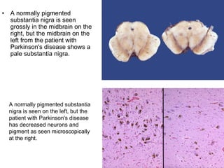 • A normally pigmented
substantia nigra is seen
grossly in the midbrain on the
right, but the midbrain on the
left from the patient with
Parkinson's disease shows a
pale substantia nigra.
A normally pigmented substantia
nigra is seen on the left, but the
patient with Parkinson's disease
has decreased neurons and
pigment as seen microscopically
at the right.
 