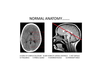 Normal Cth Brain CT Anatomy and Basic Interpretation Part I | PPT