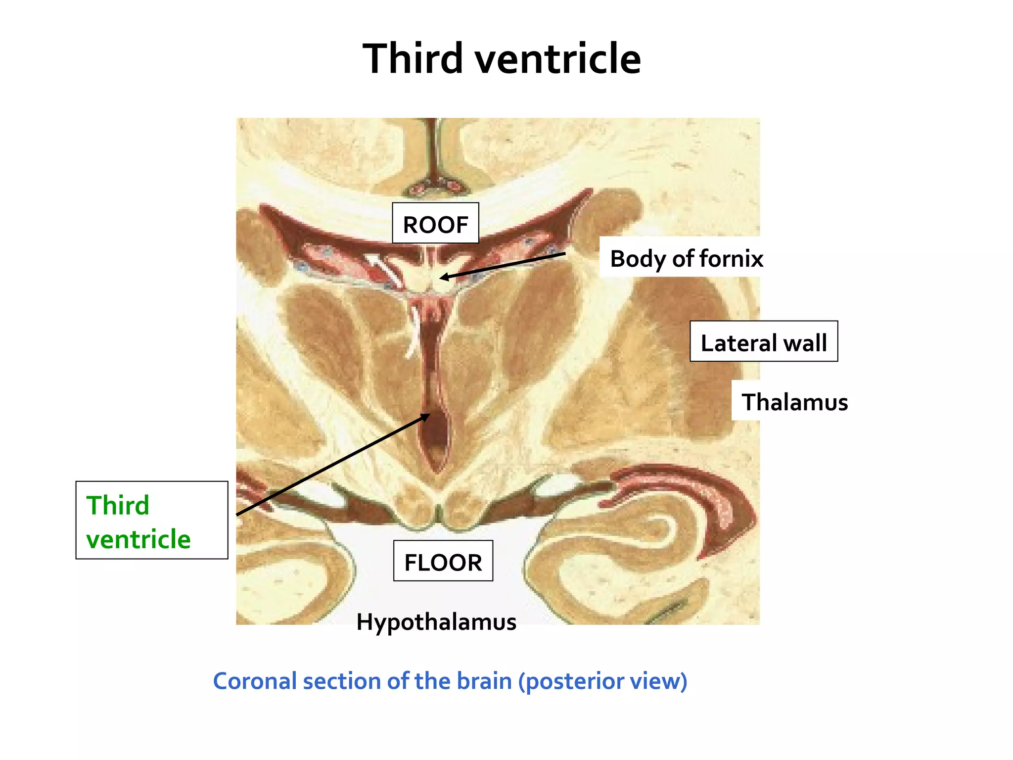 Third
ventricle
Hypothalamus
Coronal section of the brain (posterior view)
Third ventricle
Thalamus
ROOF
FLOOR
Lateral wall
Body of fornix
 