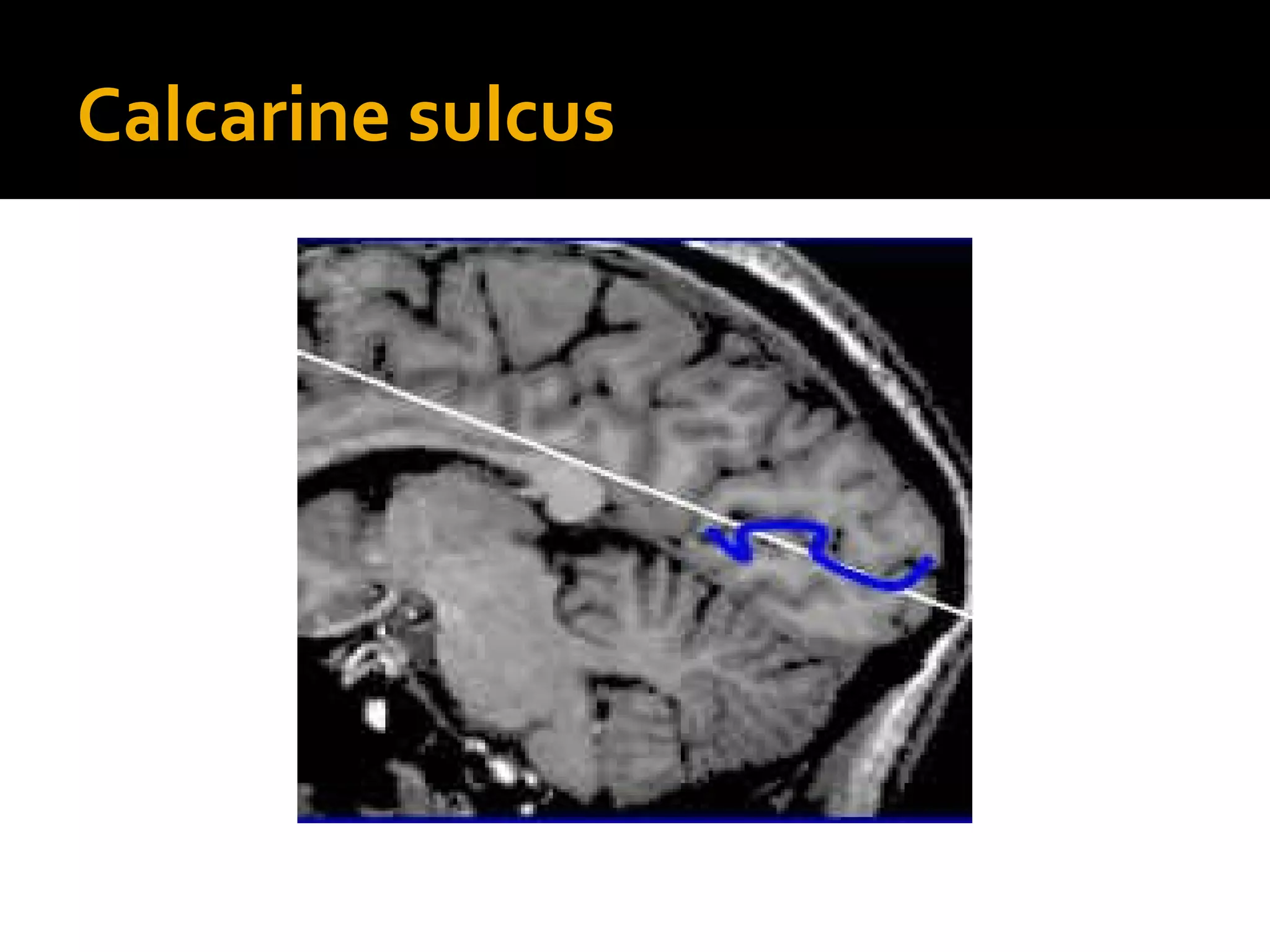 Calcarine sulcus
 