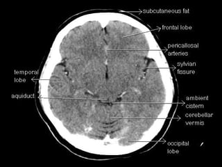 Brain CT Anatomy and Basic Interpretation Part II | PPT