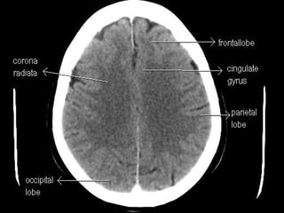 Brain CT Anatomy and Basic Interpretation Part II | PPT