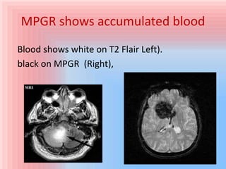 Brain ct and mri in icu | PPTX
