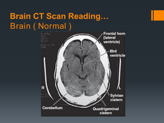 Brain ct interpretation.pdf