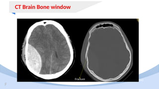 BRAIN CT PRESENTATION. FOR ALL RADIOLOGY STAFF | PPTX